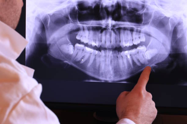 Best Knocked-Out Tooth (Avulsed Tooth) Treatment in Oliver Springs, TN